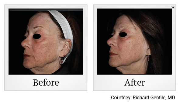 Results of EmFace treatment at Bay Area Med Spas in Oakland and Fremont